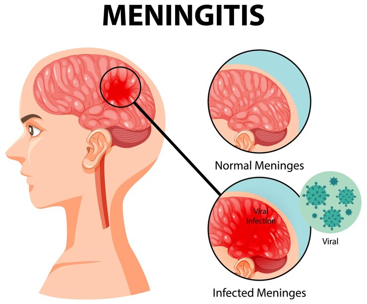 Meniere’s Disease Treatment